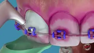 How to use the AIRFLOW® MAX