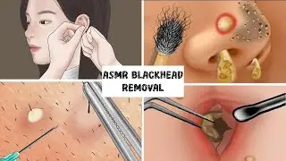 ASMR Blackhead removal collection and treatment to remove secretions caused at eyes nose, head asmr