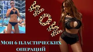 Мои 6 пластических операций.Увеличение груди, отопластика, липофилинг, удаление комков Биша