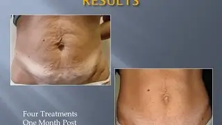 velashape behandeling MSLVS02 before after