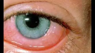 allergic conjunctivitis