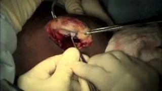 Marc Knee Cartilage Transplant - DeNovo Surgical Technique - Alan S. Nasar, MD - AOSMI