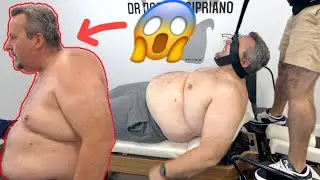 SEVERE HYPERKYPHOSIS HUNCHBACK *Pain & Immobility* Chiropractic Cracking by Dr Cipriano