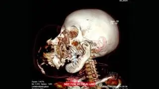 The Boy With No Face: Extraordinary People | Channel 5
