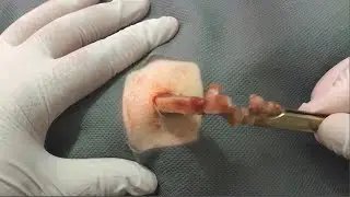 Treatment Of Blackhead Removal at Lam Dep Spa #035