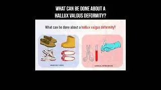 What can be done about a hallux valgus deformity? #hallux #halluxvalgus #footpain #foot
