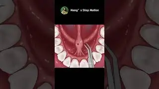 ASMR Animation | Tongue Cleaning | White Tongue | Tonsil Stone Removal! | Meng's Stop Motion