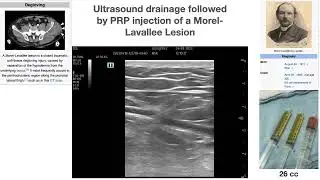 Ultrasound guided drainage of a Morel Lavalle Lesion, followed by PRP injection