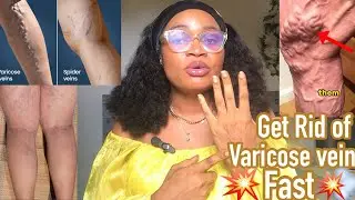 Best body treatment lotion for green veins no one is talking about #varicose #vein & spider veins