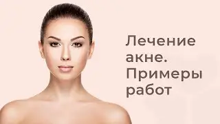 Лечение акне  Примеры работ