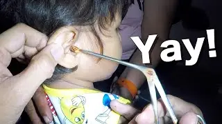 Something Orange & HUGE Stuck in His Ear Removed | What is It?