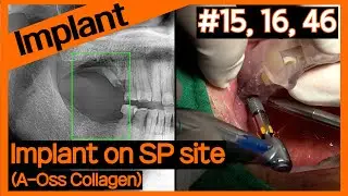 [Online Surgery] OneGuide implants on #15, #16, #46 after SP using A-Oss Collagen