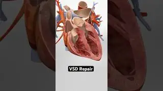 Fixing a “Hole in the Heart” — VSD Repair