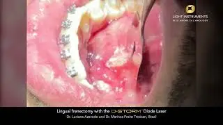 Lingual frenectomy pocket with the D-Storm™ Diode Laser