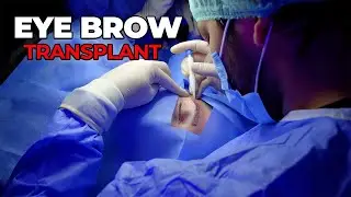 Eye Brow Transplant - Natural Results
