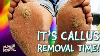 It’s Callus Removal Time! Trimming Multiple Thick Calluses
