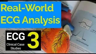 Real-World ECG Analysis (3): Clinical Case Studies in Electrocardiography.
