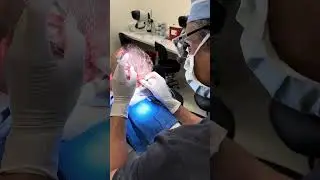 1900 FUE Hair transplant | Anthony Bared MD, FACS | Miami, FL