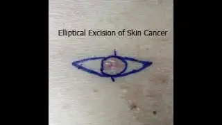 Elliptical Excision Simple of Skin Cancer   Dr Peter Kim