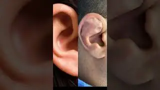 👂🥷Guess The Diagnosis:  Hematoma of the ear after mixed martial arts (MMA) fighting.