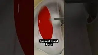 Patching a leaky spine - with blood! (3D Animation)