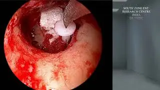 ENDOSCOPIC TYMPANOPLASTY SHEES TEFLON PORP