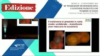 X Workshop - C. Mosci - Melanoma e nevi dell'occhio, il parere dell'oculista