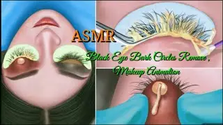 ASMR Black Eye Bark Circles Remove/Makeup Animation @ASMRanimation1234 #blackheads#scalpcare#asmr