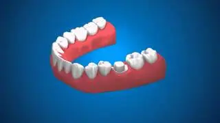 Ортопедическая стоматология  Снятие слепков и одиночные коронки
