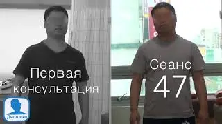 Пример лечения Дистония