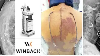 TECAR Terapia WINBACK post intervento di artrodesi - stabilizzazione vertebrale C3-C4 e T3-T7