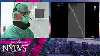 LIVE CASE PRESENTATION #2   CALCIFIED COMBINED ILIAC AND CFA ILIOFEMORAL DISEASE INTERVENTION   Broa