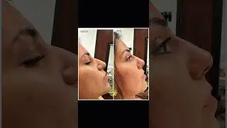 Double Rhinoplasty