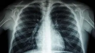 PREPARING FOR A CHEST X-RAY AND WHAT IT INVOLVES