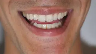Understanding No Prep Veneers: What You Need to Know