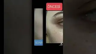 leke kremi setimizden gelen memnuniyet videosu