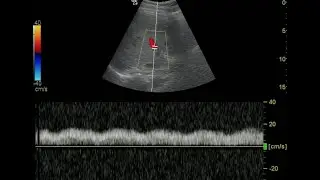 Portal Vein Doppler - Normal Monophasic Flow