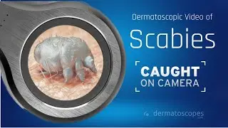 Dermoscopy of Crusted Scabies!