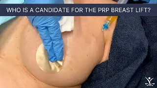 Natural Breast Enhancement with the Vampire Breast Lift (VBL)
