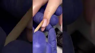 Восстановление архитектуры онихогрифозных ногтей 👍🏻👈🏻💅🏻