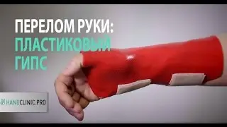 Перелом руки: пластиковый гипс при переломе лучевой кости ОЧЕНЬ УДОБНО!