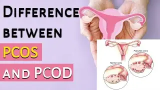 PCOD/ PCOS का मतलब, लक्षण और निदान | PCOS/ PCOD - Symptoms & Diagnosis | Dr Garima Srivastav