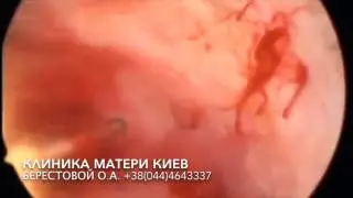 УЖАС АНОМАЛЬНЫХ ПОЛОСТЕЙ МАТКИ! ГИстероскопия при дистрофии эндометрия и тубулярных полостях