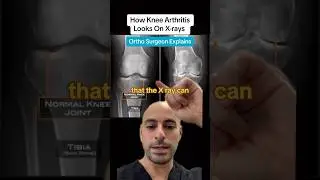 Finding Knee Arthritis in X-rays #shorts