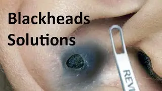 Unmasking Monster Blackheads: Facts and Solutions | Facts About Monster Blackheads in Ear