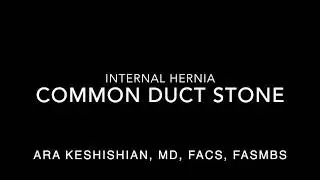 MRCP-Common Duct Stone