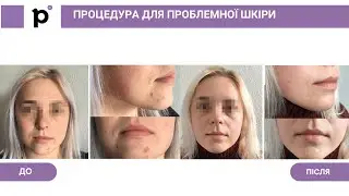 Процедура для проблемної шкіри