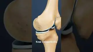 Knee Osteoarthritis