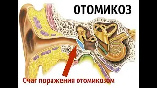 Отомикоз (грибок в ушах)