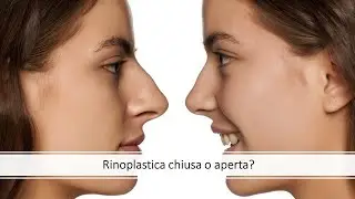Rinoplastica chiusa o rinoplastica aperta? || Dott Paolo Montemurro - Chirurgo Plastico